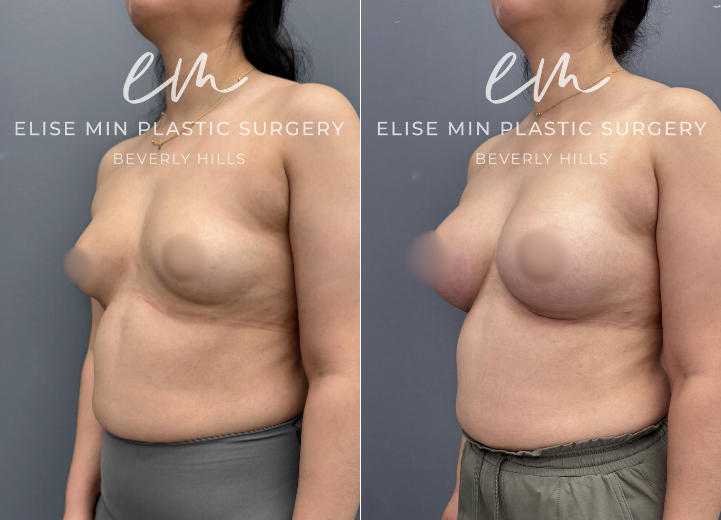 This 30-year-old patient underwent bilateral breast augmentation using Motiva Ergonomix ESRD 285cc silicone implants. The implants were placed in the subfascial plane through an inframammary incision. The result shows enhanced fullness and natural contour while maintain proportion to her frame.