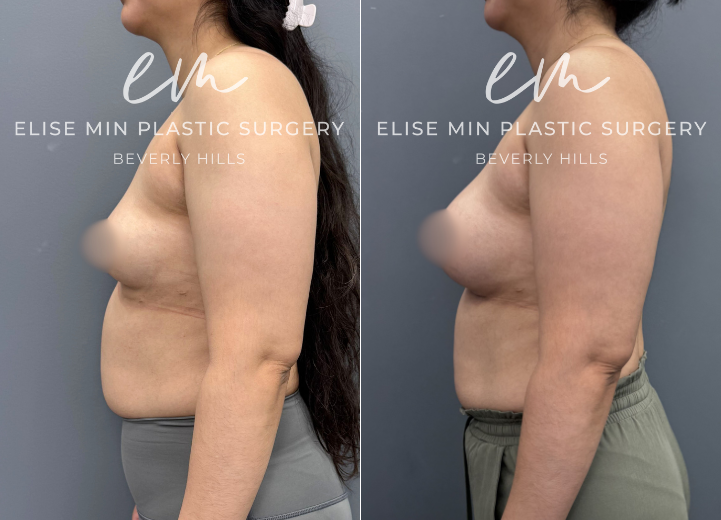 This 30-year-old patient underwent bilateral breast augmentation using Motiva Ergonomix ESRD 285cc silicone implants. The implants were placed in the subfascial plane through an inframammary incision. The result shows enhanced fullness and natural contour while maintain proportion to her frame.