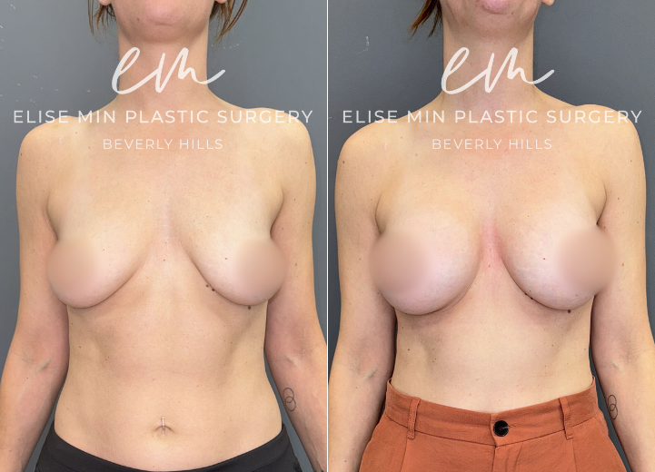 BRAUG_SSM 330 with galaflex subfascial front BRAUG_SSM 330 with galaflex subfascial front