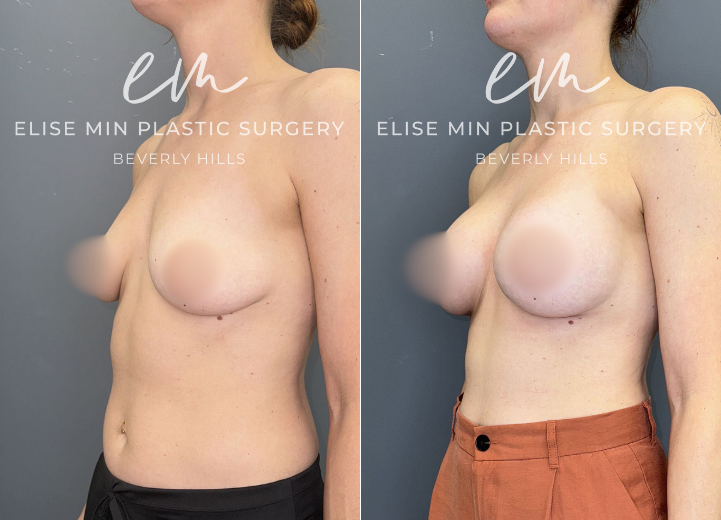 This 37-year-old patient underwent bilateral breast augmentation using Allergan Natrelle Inspira Soft Touch 330cc moderate-profile (SSM) silicone implants. The implants were placed in the subfascial plane through an inframammary incision with an added soft tissue support in the lower pole of the breasts with Galaflex synthetic absorbable mesh. Photos demonstrate improved upper-pole fullness and balanced, natural symmetry consistent with her body shape.