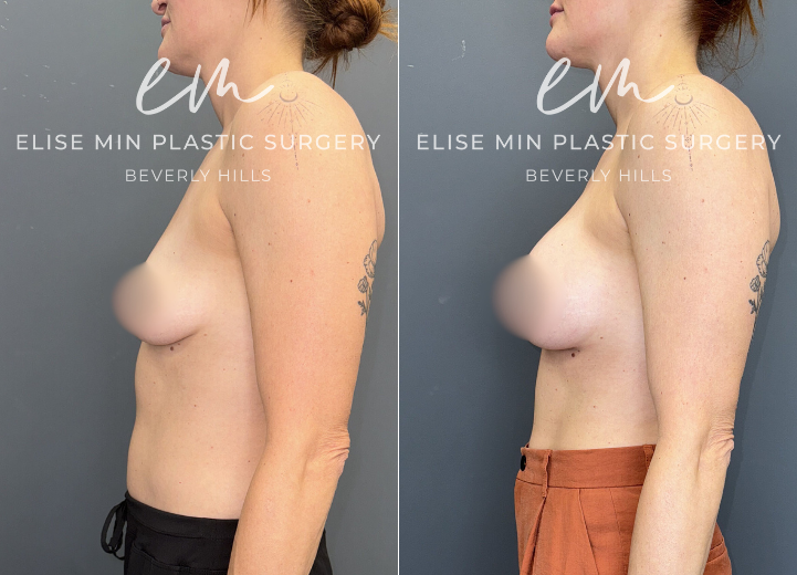 This 37-year-old patient underwent bilateral breast augmentation using Allergan Natrelle Inspira Soft Touch 330cc moderate-profile (SSM) silicone implants. The implants were placed in the subfascial plane through an inframammary incision with an added soft tissue support in the lower pole of the breasts with Galaflex synthetic absorbable mesh. Photos demonstrate improved upper-pole fullness and balanced, natural symmetry consistent with her body shape.