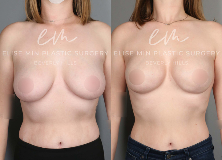 With an extensive family history of breast cancer and a genetic test confirming her increased risk of breast cancer,  this 29-year-old patient underwent a prophylactic nipple-sparing mastectomy and received an immediate breast reconstruction at the same time with Sientra moderate plus 415cc silicone breast implants above the pectoralis muscle. Her preoperative breast size was 32DD, and she wanted to stay similar in size. She healed beautifully from the procedure along with the relief that her future risk of breast cancer is significantly lower.