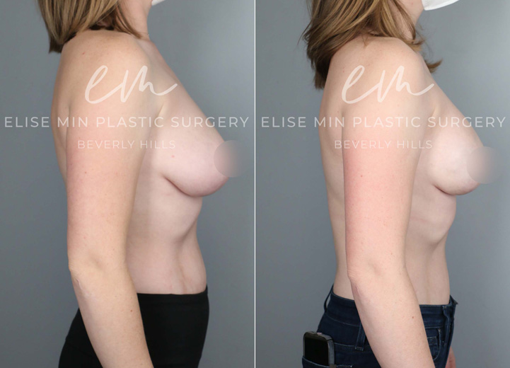 With an extensive family history of breast cancer and a genetic test confirming her increased risk of breast cancer,  this 29-year-old patient underwent a prophylactic nipple-sparing mastectomy and received an immediate breast reconstruction at the same time with Sientra moderate plus 415cc silicone breast implants above the pectoralis muscle. Her preoperative breast size was 32DD, and she wanted to stay similar in size. She healed beautifully from the procedure along with the relief that her future risk of breast cancer is significantly lower.