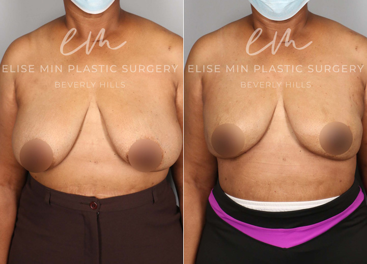 This is a 57-year-old nurse who was found to have multiple cysts and atypical breast lesions in the context of a significant family history of breast cancer. After discussing her case with her breast surgeon, she decided to pursue a prophylactic nipple-sparing mastectomy to reduce her future chance of breast cancer. From the reconstruction standpoint, she desired breasts that looked similar to her natural breasts. After her breast tissues were removed by the breast surgeon, she had Allergen moderate profile 600cc implants placed above the chest muscle with acellular dermal matrix mesh coverage. She was thrilled to have the results that made her feel as if she still had her natural breasts but with a lower risk of future breast cancer.