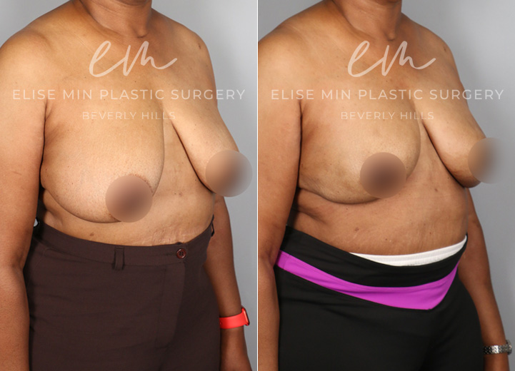 This is a 57-year-old nurse who was found to have multiple cysts and atypical breast lesions in the context of a significant family history of breast cancer. After discussing her case with her breast surgeon, she decided to pursue a prophylactic nipple-sparing mastectomy to reduce her future chance of breast cancer. From the reconstruction standpoint, she desired breasts that looked similar to her natural breasts. After her breast tissues were removed by the breast surgeon, she had Allergen moderate profile 600cc implants placed above the chest muscle with acellular dermal matrix mesh coverage. She was thrilled to have the results that made her feel as if she still had her natural breasts but with a lower risk of future breast cancer.