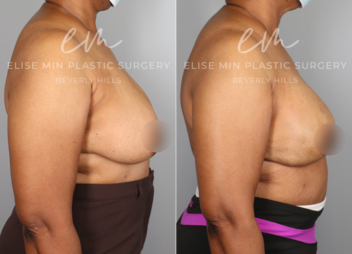 This is a 57-year-old nurse who was found to have multiple cysts and atypical breast lesions in the context of a significant family history of breast cancer. After discussing her case with her breast surgeon, she decided to pursue a prophylactic nipple-sparing mastectomy to reduce her future chance of breast cancer. From the reconstruction standpoint, she desired breasts that looked similar to her natural breasts. After her breast tissues were removed by the breast surgeon, she had Allergen moderate profile 600cc implants placed above the chest muscle with acellular dermal matrix mesh coverage. She was thrilled to have the results that made her feel as if she still had her natural breasts but with a lower risk of future breast cancer.