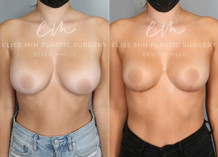 This is a 22 year-old woman with 32DD breasts who felt that her breasts did not match her petite torso. She was experiencing neck and back pain and ideally wanted to be a C cup. The patient underwent a small breast reduction (130g removed from each breast), which included a breast lift procedure. She had the procedure done using a minimal scar approach with a lollipop incision. This is a good example that every breast reduction patient receives a breast lift procedure to achieve perkier breasts.