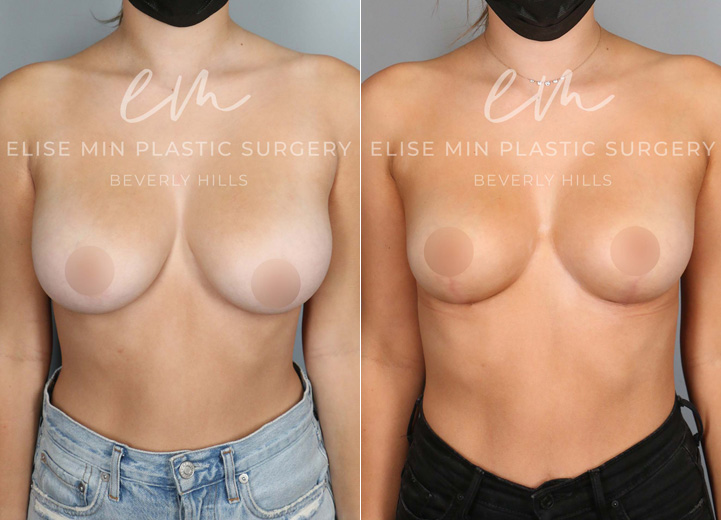 This is a 22 year-old woman with 32DD breasts who felt that her breasts did not match her petite torso. She was experiencing neck and back pain and ideally wanted to be a C cup. The patient underwent a small breast reduction (130g removed from each breast), which included a breast lift procedure. She had the procedure done using a minimal scar approach with a lollipop incision. This is a good example that every breast reduction patient receives a breast lift procedure to achieve perkier breasts.