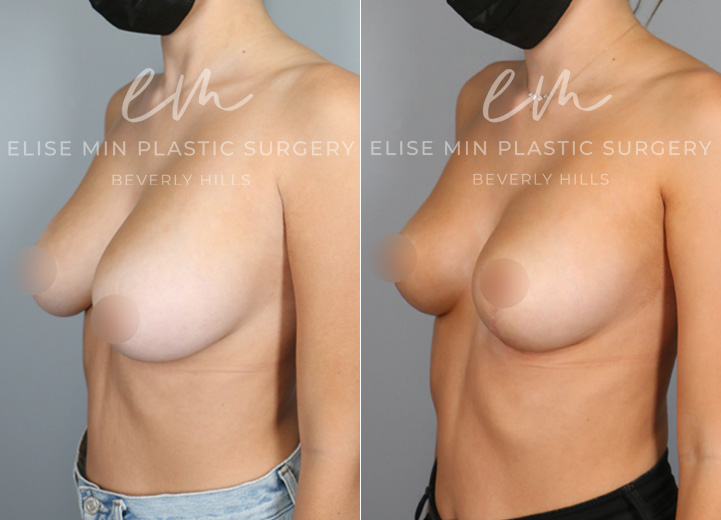 This is a 22 year-old woman with 32DD breasts who felt that her breasts did not match her petite torso. She was experiencing neck and back pain and ideally wanted to be a C cup. The patient underwent a small breast reduction (130g removed from each breast), which included a breast lift procedure. She had the procedure done using a minimal scar approach with a lollipop incision. This is a good example that every breast reduction patient receives a breast lift procedure to achieve perkier breasts.