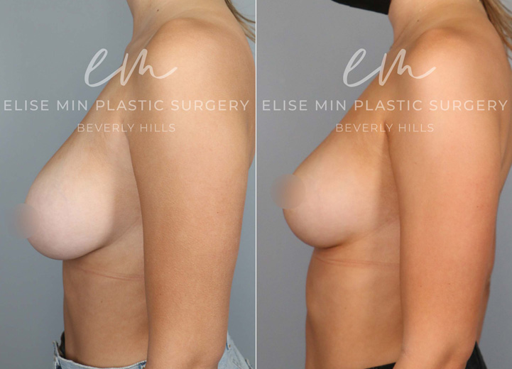 This is a 22 year-old woman with 32DD breasts who felt that her breasts did not match her petite torso. She was experiencing neck and back pain and ideally wanted to be a C cup. The patient underwent a small breast reduction (130g removed from each breast), which included a breast lift procedure. She had the procedure done using a minimal scar approach with a lollipop incision. This is a good example that every breast reduction patient receives a breast lift procedure to achieve perkier breasts.