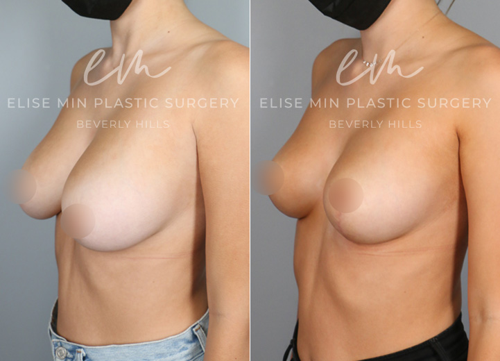 This is a 22 year-old woman with 32DD breasts who felt that her breasts did not match her petite torso. She was experiencing neck and back pain and ideally wanted to be a C cup. The patient underwent a small breast reduction (130g removed from each breast), which included a breast lift procedure. She had the procedure done using a minimal scar approach with a lollipop incision. This is a good example that every breast reduction patient receives a breast lift procedure to achieve perkier breasts.