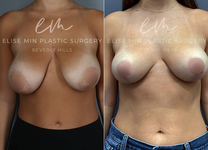 This is a 23-year-old woman who had been considering a breast reduction since she was a teenager. She experienced the weight of her droopy breasts affecting her posture over the years. She underwent a vertical breast reduction with the minimal scar approach ('lollipop'-scar) and had 120g removed from the left breast and 160g removed from the right breast. She went from DDD cup-sized breasts to her desired C cup-size after the procedure. 