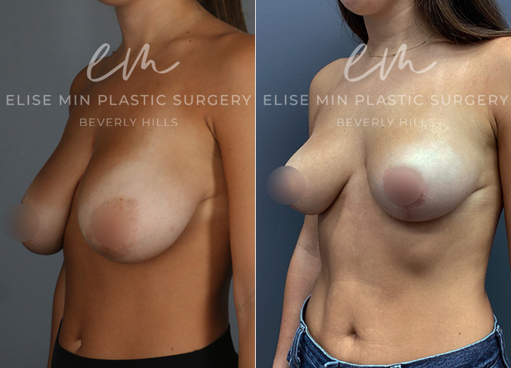 This is a 23-year-old woman who had been considering a breast reduction since she was a teenager. She experienced the weight of her droopy breasts affecting her posture over the years. She underwent a vertical breast reduction with the minimal scar approach ('lollipop'-scar) and had 120g removed from the left breast and 160g removed from the right breast. She went from DDD cup-sized breasts to her desired C cup-size after the procedure. 