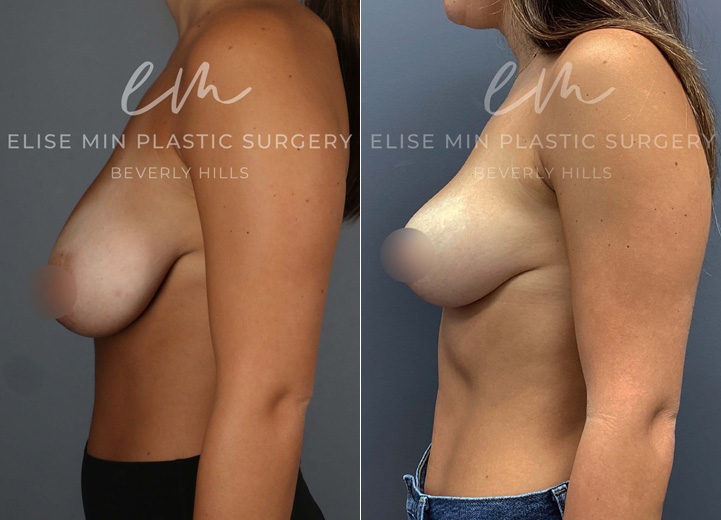 This is a 23-year-old woman who had been considering a breast reduction since she was a teenager. She experienced the weight of her droopy breasts affecting her posture over the years. She underwent a vertical breast reduction with the minimal scar approach ('lollipop'-scar) and had 120g removed from the left breast and 160g removed from the right breast. She went from DDD cup-sized breasts to her desired C cup-size after the procedure. 