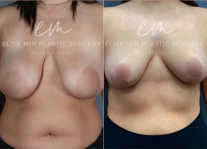 This 25-year-old patient struggled with heavy breasts that caused neck and back tension. She underwent a breast reduction, with 560g of tissue removed from the right breast and 400g from the left, along with liposuction of the lateral chest roll and axillary fullness. This procedure helped her achieve a more balanced, perkier, and lighter look, bringing both physical relief and aesthetic enhancement.