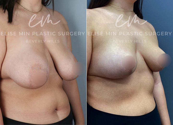 This 25-year-old patient struggled with heavy breasts that caused neck and back tension. She underwent a breast reduction, with 560g of tissue removed from the right breast and 400g from the left, along with liposuction of the lateral chest roll and axillary fullness. This procedure helped her achieve a more balanced, perkier, and lighter look, bringing both physical relief and aesthetic enhancement.