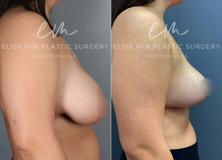 This 25-year-old patient struggled with heavy breasts that caused neck and back tension. She underwent a breast reduction, with 560g of tissue removed from the right breast and 400g from the left, along with liposuction of the lateral chest roll and axillary fullness. This procedure helped her achieve a more balanced, perkier, and lighter look, bringing both physical relief and aesthetic enhancement.