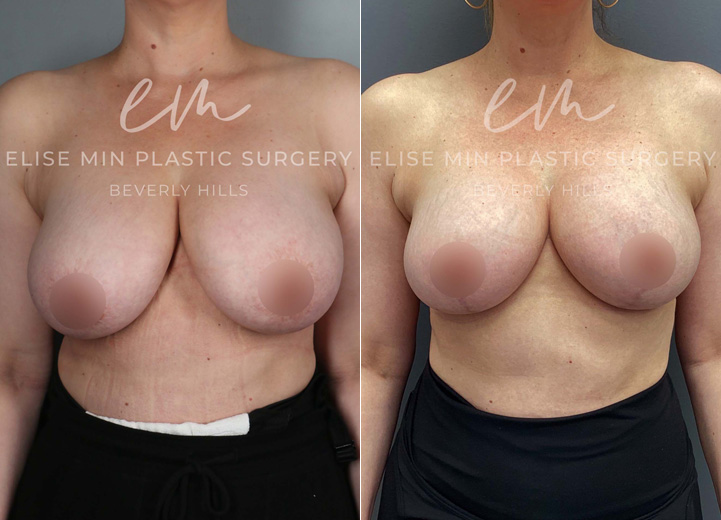 This 45-year-old patient wanted perkier breasts while slightly reducing her volume. She underwent a bilateral breast reduction, with 150g of tissue removed from each breast, achieving a more lifted and balanced shape. She was thrilled with her lighter, more youthful-looking results!