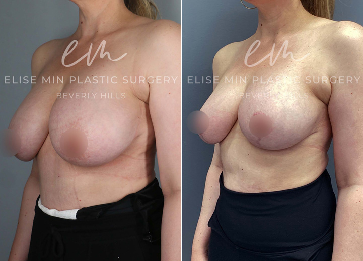 This 45-year-old patient wanted perkier breasts while slightly reducing her volume. She underwent a bilateral breast reduction, with 150g of tissue removed from each breast, achieving a more lifted and balanced shape. She was thrilled with her lighter, more youthful-looking results!