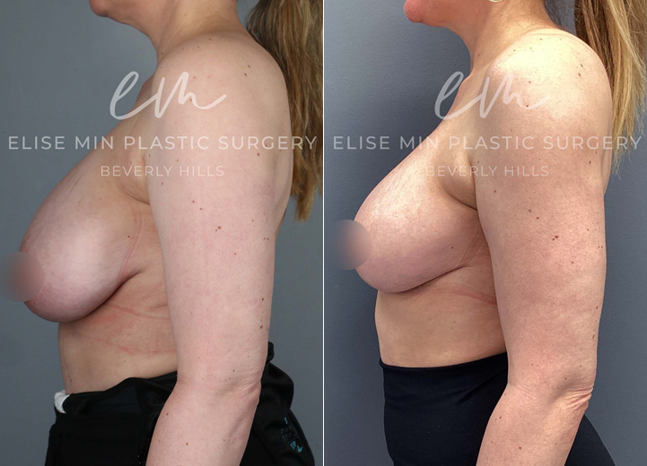 This 45-year-old patient wanted perkier breasts while slightly reducing her volume. She underwent a bilateral breast reduction, with 150g of tissue removed from each breast, achieving a more lifted and balanced shape. She was thrilled with her lighter, more youthful-looking results!