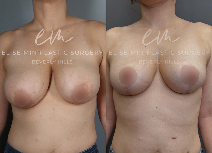 This 40-year-old patient had DD-sized breasts and desired a C cup for a lighter, more comfortable fit. She underwent a breast reduction, with 250g and 270g of tissue removed from each breast, achieving a more proportionate shape. To enhance long-term support, she also opted for synthetic absorbable mesh (Galaflex) as an internal sling, often called an “internal bra.”