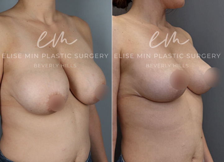This 40-year-old patient had DD-sized breasts and desired a C cup for a lighter, more comfortable fit. She underwent a breast reduction, with 250g and 270g of tissue removed from each breast, achieving a more proportionate shape. To enhance long-term support, she also opted for synthetic absorbable mesh (Galaflex) as an internal sling, often called an “internal bra.”