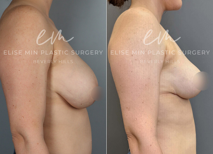 This 40-year-old patient had DD-sized breasts and desired a C cup for a lighter, more comfortable fit. She underwent a breast reduction, with 250g and 270g of tissue removed from each breast, achieving a more proportionate shape. To enhance long-term support, she also opted for synthetic absorbable mesh (Galaflex) as an internal sling, often called an “internal bra.”