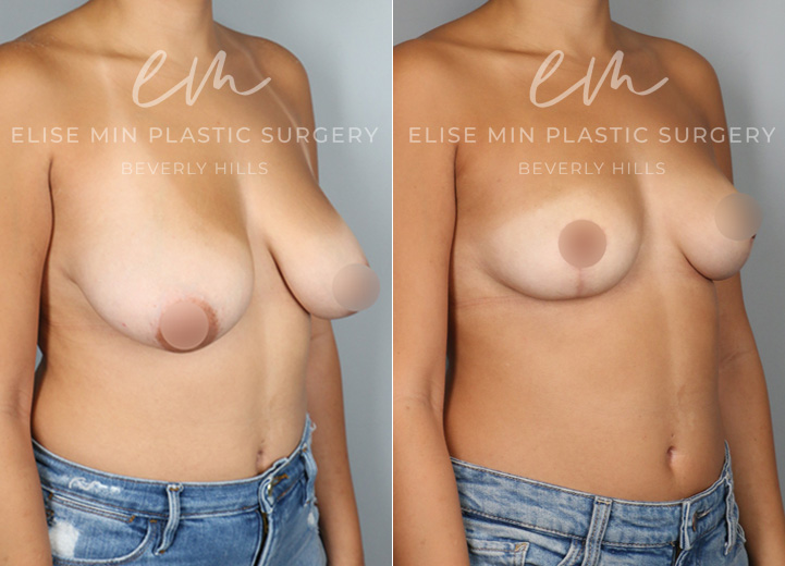 This is a petite 33-year-old woman who had been considering a breast reduction procedure for many years. She felt that her breast size did not match her petite frame and experienced the weight of her droopy breasts affecting her posture over the years. She underwent a vertical breast reduction with the minimal scar approach ('lollipop'-scar) and had 173g removed from the left breast and 139g removed from the right breast. She went from 30DDD cup-sized breasts to her desired C cup-size after the procedure. She was excited to share that her posture improved, and feeling a lot lighter in the chest, she's enjoying not wearing a bra at all.