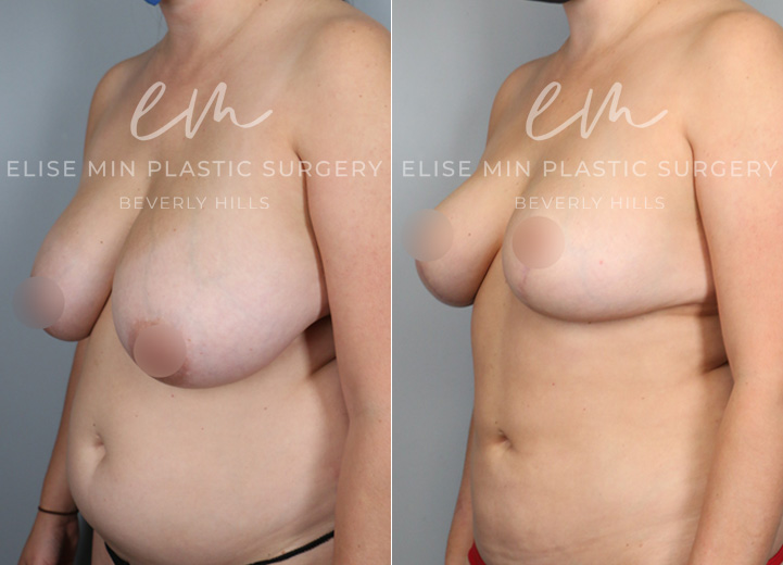 This is a 30-year-old woman who had been considering a breast reduction procedure since she was a teenager. She had been seeing a chiropractor for over a decade but her neck and back pain never improved. She underwent a vertical breast reduction with the minimal scar approach ('lollipop'-scar) and had 420g removed from the left breast and 370g removed from the right breast. She wasn’t sure what her cup size was prior to surgery but postoperatively, she was fitting into a C cup-size. Her neck and back pain also fully went away after the surgery.