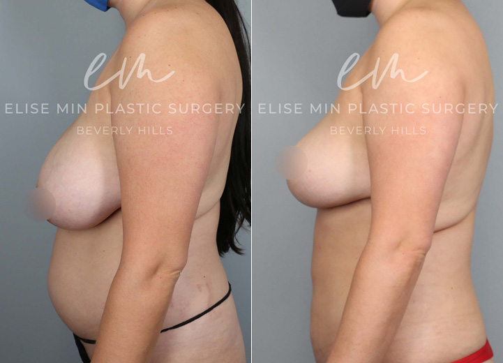 This is a 30-year-old woman who had been considering a breast reduction procedure since she was a teenager. She had been seeing a chiropractor for over a decade but her neck and back pain never improved. She underwent a vertical breast reduction with the minimal scar approach ('lollipop'-scar) and had 420g removed from the left breast and 370g removed from the right breast. She wasn’t sure what her cup size was prior to surgery but postoperatively, she was fitting into a C cup-size. Her neck and back pain also fully went away after the surgery.