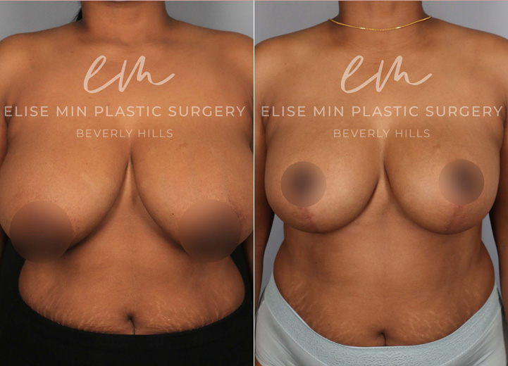 This is a 37-year-old woman who had been considering a breast reduction procedure due to her severe upper back pain and frequent skin irritation along her breast fold. She underwent a vertical breast reduction with the minimal scar approach ('lollipop'-scar) and had 400g removed from the left breast and 380g removed from the right breast. She wanted a fuller, feminine look and was fitting into a D cup-size postoperatively. 