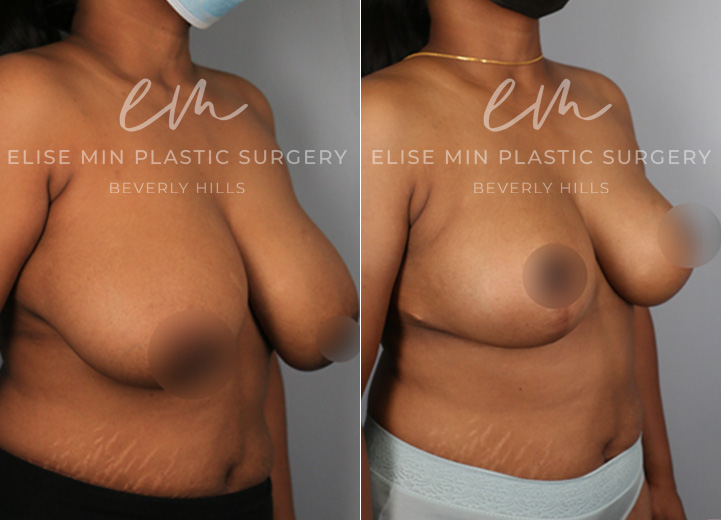 This is a 37-year-old woman who had been considering a breast reduction procedure due to her severe upper back pain and frequent skin irritation along her breast fold. She underwent a vertical breast reduction with the minimal scar approach ('lollipop'-scar) and had 400g removed from the left breast and 380g removed from the right breast. She wanted a fuller, feminine look and was fitting into a D cup-size postoperatively. 