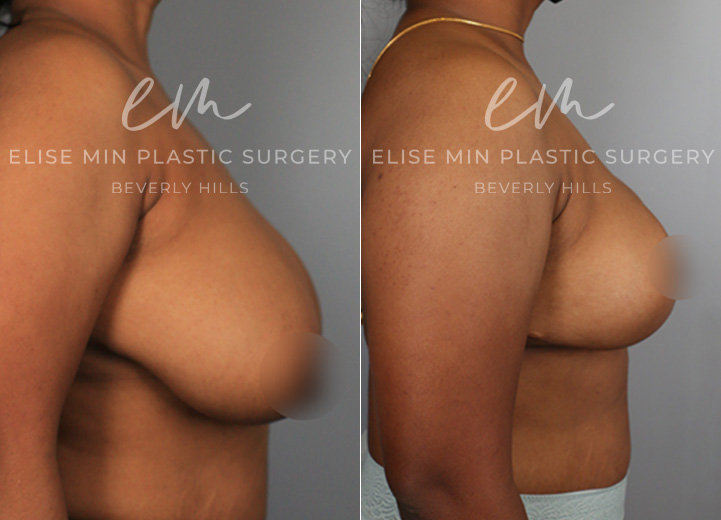 This is a 37-year-old woman who had been considering a breast reduction procedure due to her severe upper back pain and frequent skin irritation along her breast fold. She underwent a vertical breast reduction with the minimal scar approach ('lollipop'-scar) and had 400g removed from the left breast and 380g removed from the right breast. She wanted a fuller, feminine look and was fitting into a D cup-size postoperatively. 