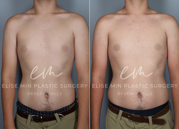 This is a 17-year-old teenage boy with gynecomastia who had been fully evaluated by his pediatric endocrinology doctor. After the workup revealed no underlying medical issues, the patient was referred for a surgical evaluation to address his protruding nipple areolar complex, with the right side being worse than the left. He felt self-conscious that the nipple area would poke through any t-shirt. He wanted to get this addressed before heading off to college and got his wish by undergoing an excision of the firm breast tissue through a short curved scar around the nipple areolar complex. Additionally, he had gentle liposuction of the adipose tissue on both sides of the chest.