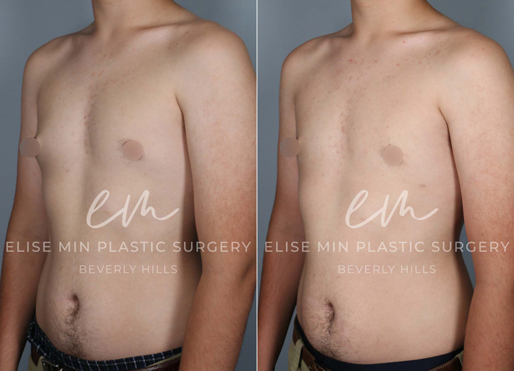 This is a 17-year-old teenage boy with gynecomastia who had been fully evaluated by his pediatric endocrinology doctor. After the workup revealed no underlying medical issues, the patient was referred for a surgical evaluation to address his protruding nipple areolar complex, with the right side being worse than the left. He felt self-conscious that the nipple area would poke through any t-shirt. He wanted to get this addressed before heading off to college and got his wish by undergoing an excision of the firm breast tissue through a short curved scar around the nipple areolar complex. Additionally, he had gentle liposuction of the adipose tissue on both sides of the chest.