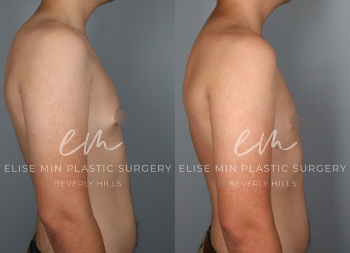 This is a 17-year-old teenage boy with gynecomastia who had been fully evaluated by his pediatric endocrinology doctor. After the workup revealed no underlying medical issues, the patient was referred for a surgical evaluation to address his protruding nipple areolar complex, with the right side being worse than the left. He felt self-conscious that the nipple area would poke through any t-shirt. He wanted to get this addressed before heading off to college and got his wish by undergoing an excision of the firm breast tissue through a short curved scar around the nipple areolar complex. Additionally, he had gentle liposuction of the adipose tissue on both sides of the chest.