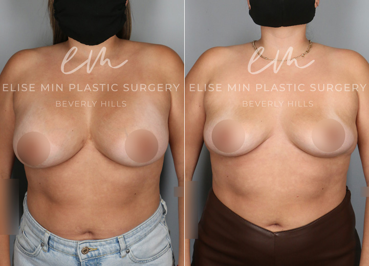 This is a 28 year-old patient who wanted her implants removed. She no longer cared for them and felt that the implants were contributing to more back pain for her. The patient also wanted to start trying to get pregnant so she wanted to get the surgery out of the way. She was initially interested in a breast lift and fat transfer at the time of the removal but after my discussion with her, she decided to see how she would bounce back with the implant removal alone. After all, she had very youthful skin and tissue and had never undergone pregnancy and breastfeeding so there was a good chance that her breasts would restore their shape without additional procedures. She had 375cc breast implants removed in the operating room and her breasts bounced back to looking natural and beautiful. She was so happy that she didn’t have to undergo additional lift and fat transfer to achieve the outcome that she did.