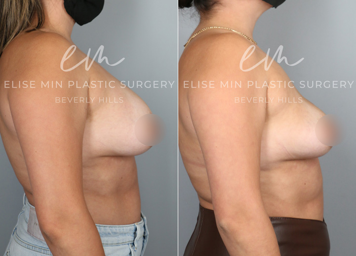 This is a 28 year-old patient who wanted her implants removed. She no longer cared for them and felt that the implants were contributing to more back pain for her. The patient also wanted to start trying to get pregnant so she wanted to get the surgery out of the way. She was initially interested in a breast lift and fat transfer at the time of the removal but after my discussion with her, she decided to see how she would bounce back with the implant removal alone. After all, she had very youthful skin and tissue and had never undergone pregnancy and breastfeeding so there was a good chance that her breasts would restore their shape without additional procedures. She had 375cc breast implants removed in the operating room and her breasts bounced back to looking natural and beautiful. She was so happy that she didn’t have to undergo additional lift and fat transfer to achieve the outcome that she did.