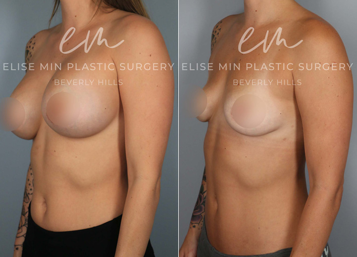 This is an active 30 year-old patient who had silicone breast implants placed ten years prior to her presentation. She started to feel her implants getting tighter, which was consistent with capsular contracture. Although she was hesitant about the size she would be post-removal, she knew for sure that she did not want them anymore. She underwent removal of 550cc silicone implants and thick capsules and concurrently underwent a “donut” mastopexy to help restore symmetry to her nipple areolas. She was baseline very fit which meant minimal donor sites to harvest fat from. However, in thin patients, even small amounts of fat can be helpful. I was able to graft 60cc of fat into each breast to help shape the breasts to make up for the stretched out appearance the large implants had left her. She used to have AA cup-sized breasts prior to implants and now she is a full A/small B cup size that she’s excited to have.