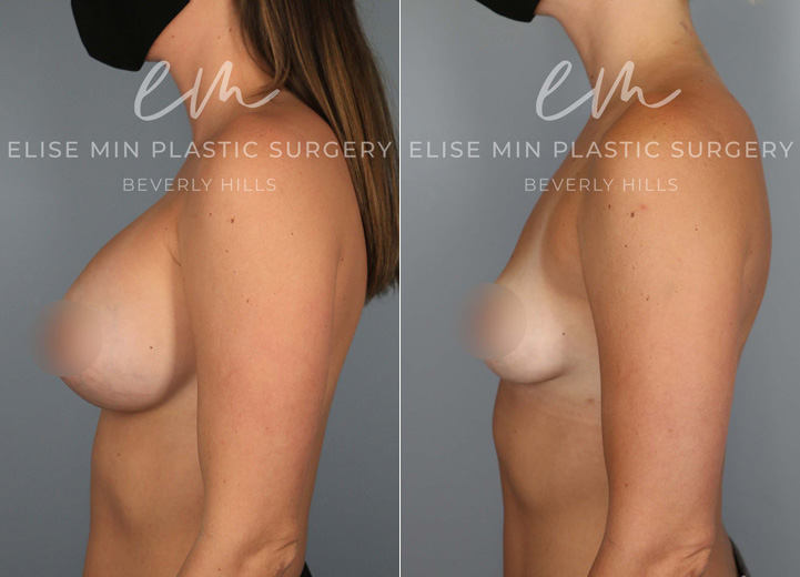 This is an active 30 year-old patient who had silicone breast implants placed ten years prior to her presentation. She started to feel her implants getting tighter, which was consistent with capsular contracture. Although she was hesitant about the size she would be post-removal, she knew for sure that she did not want them anymore. She underwent removal of 550cc silicone implants and thick capsules and concurrently underwent a “donut” mastopexy to help restore symmetry to her nipple areolas. She was baseline very fit which meant minimal donor sites to harvest fat from. However, in thin patients, even small amounts of fat can be helpful. I was able to graft 60cc of fat into each breast to help shape the breasts to make up for the stretched out appearance the large implants had left her. She used to have AA cup-sized breasts prior to implants and now she is a full A/small B cup size that she’s excited to have.