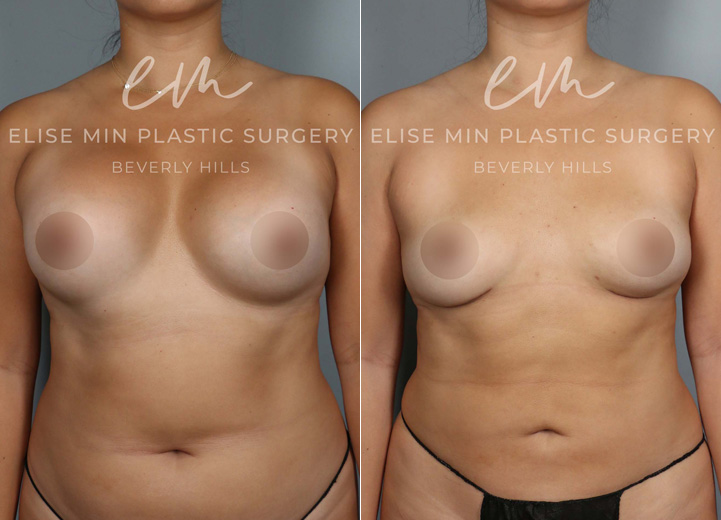 This 45 year-old patient had her implants placed two decades ago and developed capsular contracture in the recent years. She felt tight in her right breast and it led to more asymmetry of her breasts. She came into the office hoping to get rid of the tightening effect of capsular contracture and restore breast symmetry. She also wanted her natural breast shape back and did not want implants anymore. Mainly she did not want more surgeries in the future. However, she was worried about how small she would be after the implant removal. She also knew implants stretch out the overlying tissue and leave a hollow appearance once the implants are removed. To help boost her post-removal volume and shape, we discussed transferring fat to the breasts. She underwent implant removal (300cc saline implants were removed) and capsulectomy to remove the thick hardened capsule. She had 170cc of fat grafted into the right breast and 100cc into the left breast to make up for the difference in the breast size. She was excited to have symmetrical breasts again and love her natural breasts that feel lighter and beautiful.