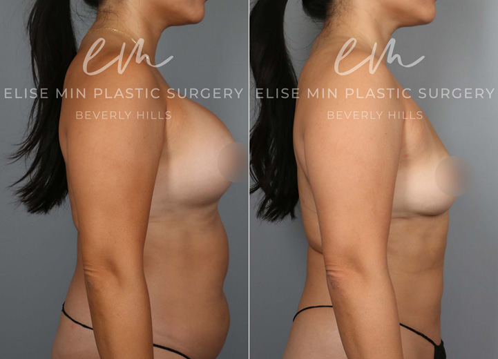 This 45 year-old patient had her implants placed two decades ago and developed capsular contracture in the recent years. She felt tight in her right breast and it led to more asymmetry of her breasts. She came into the office hoping to get rid of the tightening effect of capsular contracture and restore breast symmetry. She also wanted her natural breast shape back and did not want implants anymore. Mainly she did not want more surgeries in the future. However, she was worried about how small she would be after the implant removal. She also knew implants stretch out the overlying tissue and leave a hollow appearance once the implants are removed. To help boost her post-removal volume and shape, we discussed transferring fat to the breasts. She underwent implant removal (300cc saline implants were removed) and capsulectomy to remove the thick hardened capsule. She had 170cc of fat grafted into the right breast and 100cc into the left breast to make up for the difference in the breast size. She was excited to have symmetrical breasts again and love her natural breasts that feel lighter and beautiful.