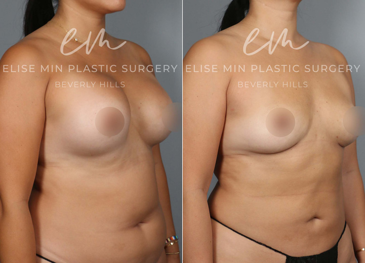 This 45 year-old patient had her implants placed two decades ago and developed capsular contracture in the recent years. She felt tight in her right breast and it led to more asymmetry of her breasts. She came into the office hoping to get rid of the tightening effect of capsular contracture and restore breast symmetry. She also wanted her natural breast shape back and did not want implants anymore. Mainly she did not want more surgeries in the future. However, she was worried about how small she would be after the implant removal. She also knew implants stretch out the overlying tissue and leave a hollow appearance once the implants are removed. To help boost her post-removal volume and shape, we discussed transferring fat to the breasts. She underwent implant removal (300cc saline implants were removed) and capsulectomy to remove the thick hardened capsule. She had 170cc of fat grafted into the right breast and 100cc into the left breast to make up for the difference in the breast size. She was excited to have symmetrical breasts again and love her natural breasts that feel lighter and beautiful.