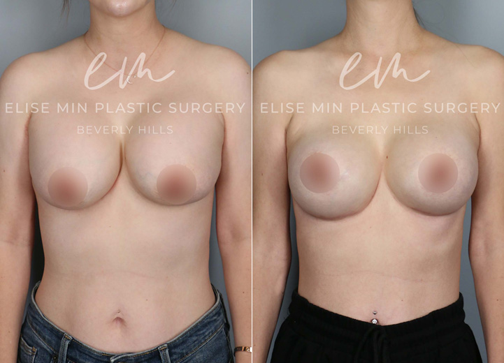 This 40-year-old mother of two initially had several breast revision surgeries by her prior plastic surgeon for recurrent capsular contracture. Unfortunately the capsular contracture returned and progressed to the point that it was visible and uncomfortable. She wanted her soft breasts back with a more natural breast shape but did not want any additional scars that would be a part of a breast lift procedure. During the operation, her Sientra 415 high profile silicone breast implants were taken out, and in their place, Sientra 445 extra-high profile silicone breast implants were put in. To address her capsular contracture, she had her thickened capsule completely removed and had acellular dermal matrix (ADM) mesh placed as an inferior sling. The ADM mesh can be useful in reducing the risk of future capsular contracture, especially in recurrent capsular contracture situation.