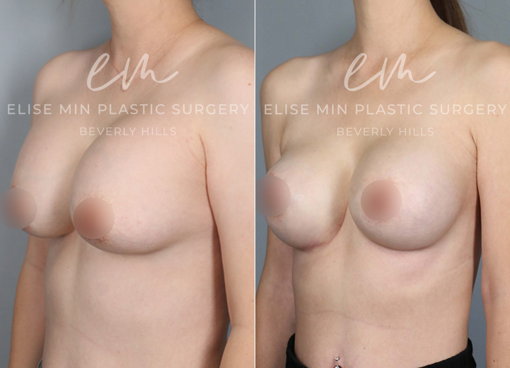 This 40-year-old mother of two initially had several breast revision surgeries by her prior plastic surgeon for recurrent capsular contracture. Unfortunately the capsular contracture returned and progressed to the point that it was visible and uncomfortable. She wanted her soft breasts back with a more natural breast shape but did not want any additional scars that would be a part of a breast lift procedure. During the operation, her Sientra 415 high profile silicone breast implants were taken out, and in their place, Sientra 445 extra-high profile silicone breast implants were put in. To address her capsular contracture, she had her thickened capsule completely removed and had acellular dermal matrix (ADM) mesh placed as an inferior sling. The ADM mesh can be useful in reducing the risk of future capsular contracture, especially in recurrent capsular contracture situation.