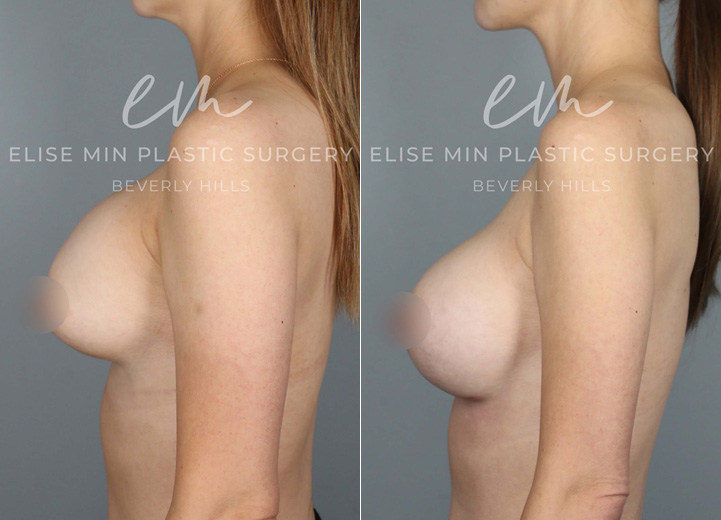 This 40-year-old mother of two initially had several breast revision surgeries by her prior plastic surgeon for recurrent capsular contracture. Unfortunately the capsular contracture returned and progressed to the point that it was visible and uncomfortable. She wanted her soft breasts back with a more natural breast shape but did not want any additional scars that would be a part of a breast lift procedure. During the operation, her Sientra 415 high profile silicone breast implants were taken out, and in their place, Sientra 445 extra-high profile silicone breast implants were put in. To address her capsular contracture, she had her thickened capsule completely removed and had acellular dermal matrix (ADM) mesh placed as an inferior sling. The ADM mesh can be useful in reducing the risk of future capsular contracture, especially in recurrent capsular contracture situation.