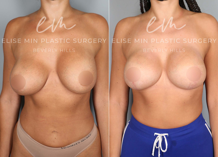 This charming 29-year-old patient had Sientra 350cc silicone breast implants placed by her prior plastic surgeon. During the first few months, she developed severe left-sided capsular contracture along with severe animation deformity (displacement of breast implants when the patient flexes her chest muscles). She desired correction of all her problems along with a larger breast size and a breast lift. During the procedure, her thick capsule was removed, and her breast implants were changed from being under the pectoralis chest muscle to over the muscle, thereby fixing her breast implant problems. Her new implant size was Sientra moderate plus 435, and with a concurrent lollipop breast lift, she was thrilled to achieve larger, perkier, and more symmetrical breasts that she had wanted from the beginning of her breast augmentation journey.