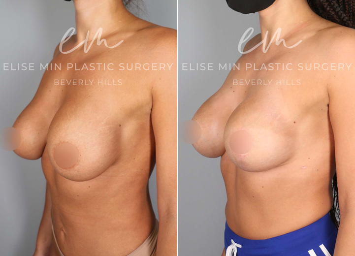 This charming 29-year-old patient had Sientra 350cc silicone breast implants placed by her prior plastic surgeon. During the first few months, she developed severe left-sided capsular contracture along with severe animation deformity (displacement of breast implants when the patient flexes her chest muscles). She desired correction of all her problems along with a larger breast size and a breast lift. During the procedure, her thick capsule was removed, and her breast implants were changed from being under the pectoralis chest muscle to over the muscle, thereby fixing her breast implant problems. Her new implant size was Sientra moderate plus 435, and with a concurrent lollipop breast lift, she was thrilled to achieve larger, perkier, and more symmetrical breasts that she had wanted from the beginning of her breast augmentation journey.