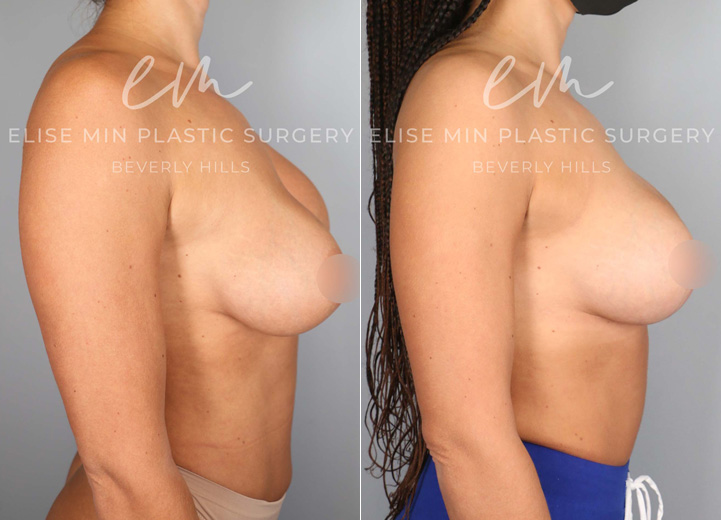 This charming 29-year-old patient had Sientra 350cc silicone breast implants placed by her prior plastic surgeon. During the first few months, she developed severe left-sided capsular contracture along with severe animation deformity (displacement of breast implants when the patient flexes her chest muscles). She desired correction of all her problems along with a larger breast size and a breast lift. During the procedure, her thick capsule was removed, and her breast implants were changed from being under the pectoralis chest muscle to over the muscle, thereby fixing her breast implant problems. Her new implant size was Sientra moderate plus 435, and with a concurrent lollipop breast lift, she was thrilled to achieve larger, perkier, and more symmetrical breasts that she had wanted from the beginning of her breast augmentation journey.