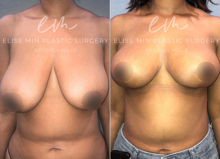 This is a woman in her 20s who underwent a 25 pound weight loss that resulted in saggy, deflated breasts. She was fitting into a DD cup-sized bra and wanted to maintain her volume but wanted perkier breasts. She initially inquired about a breast implant to achieve this and I explained that she has adequate breast tissue to help achieve what she wants without implants. She was thrilled to hear this and underwent a vertical (